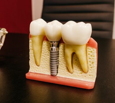 implant dental