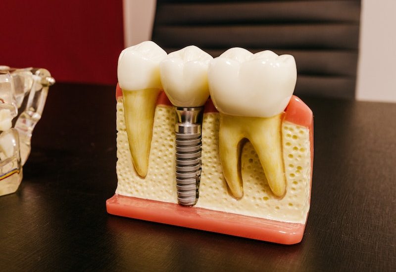 implant dental